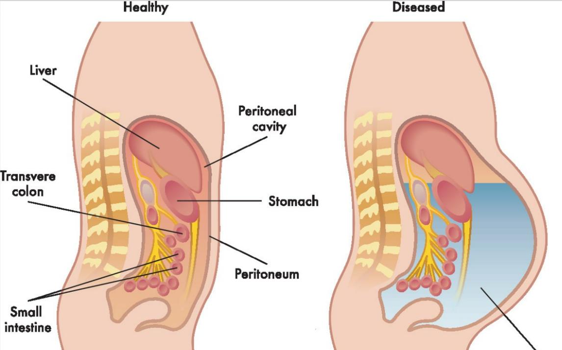 肝病介入专家岳振东：运用TIPS解决布加综合征门脉高压患者病痛
