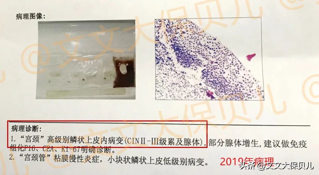 cin2-3累及腺体是宫颈癌吗,cin3级并累及腺体到宫颈癌多久