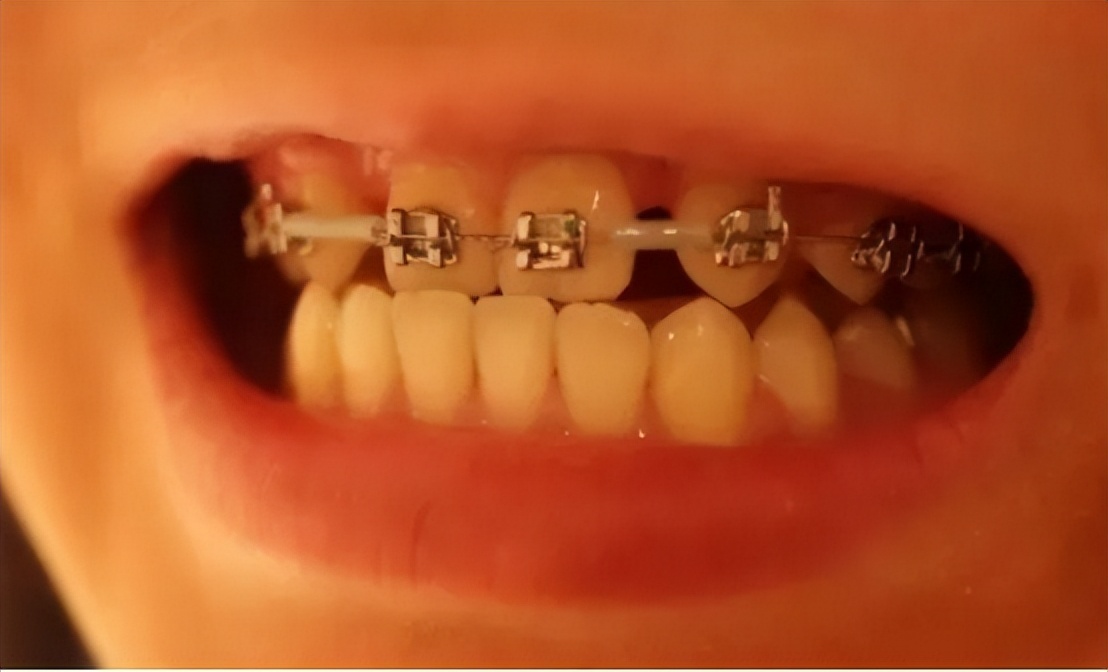 牙齿矫正过程口腔护理,口腔科普牙齿矫正的十大误区