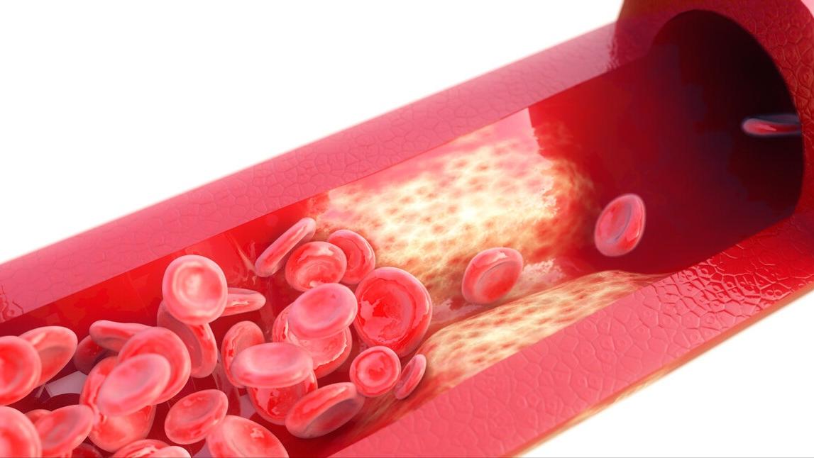 家人突发脑出血咋办？医生教你家庭急救办法，身边有高血压的请看