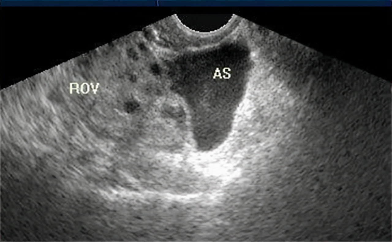 憋尿黄体破裂是怎么回事,运动可能导致黄体破裂吗