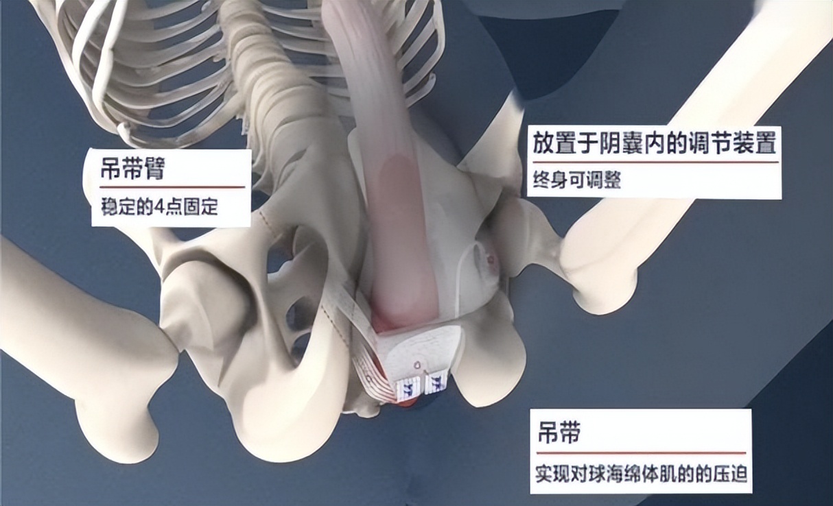 阴部神经电针刺激联合盆底肌锻炼治疗前列腺癌术后尿*禁失**