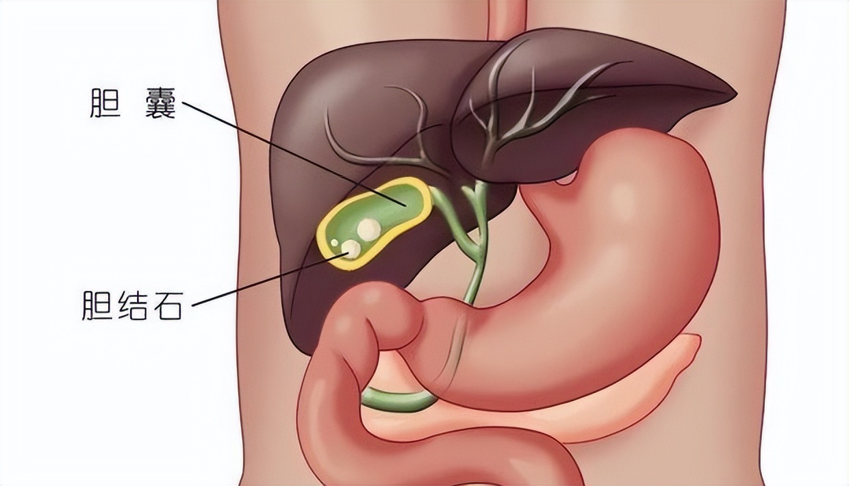 胆囊息肉切除后遗症怎样才能恢复,手术切除胆后有什么影响