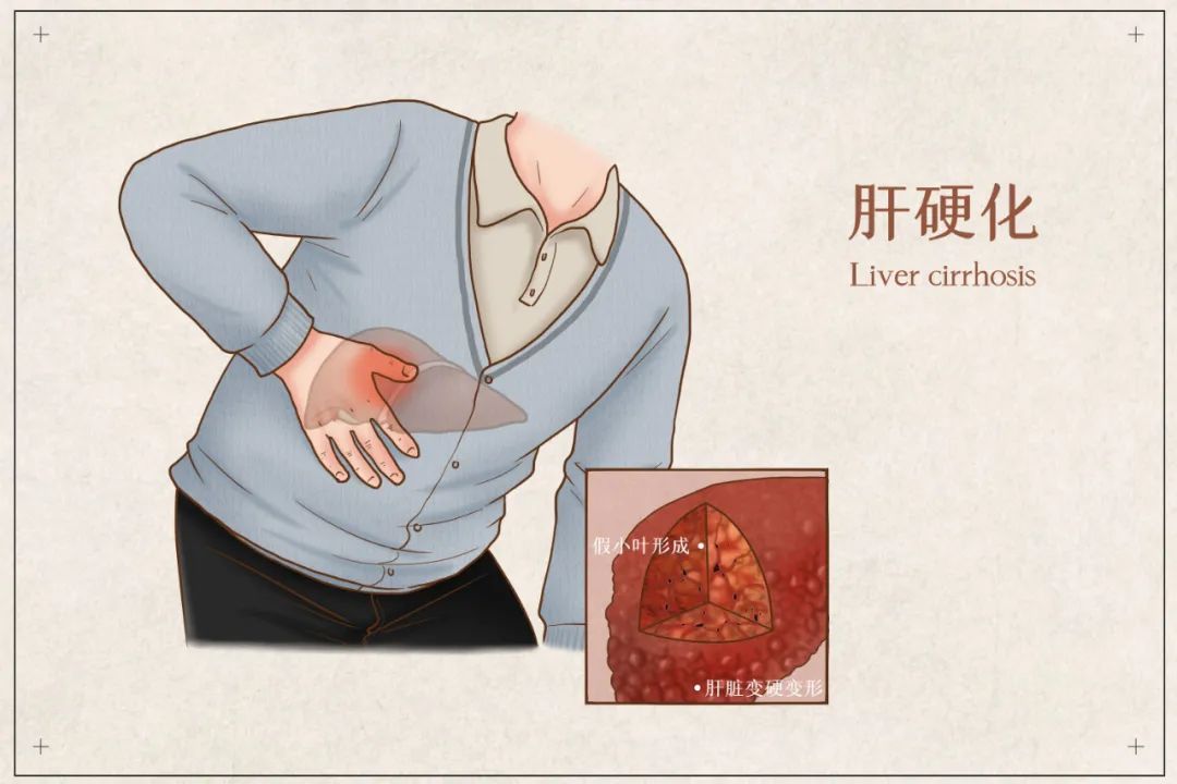 肝硬化干细胞移植改善肝功能,干细胞治疗秒懂