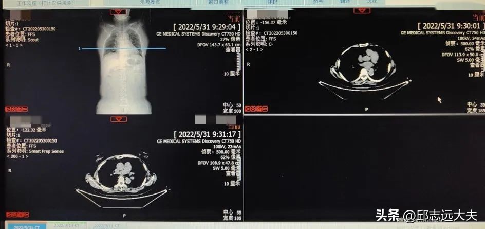 子宫肉瘤化疗较好的药物,pd-1单抗治疗晚期肺癌有效率高吗