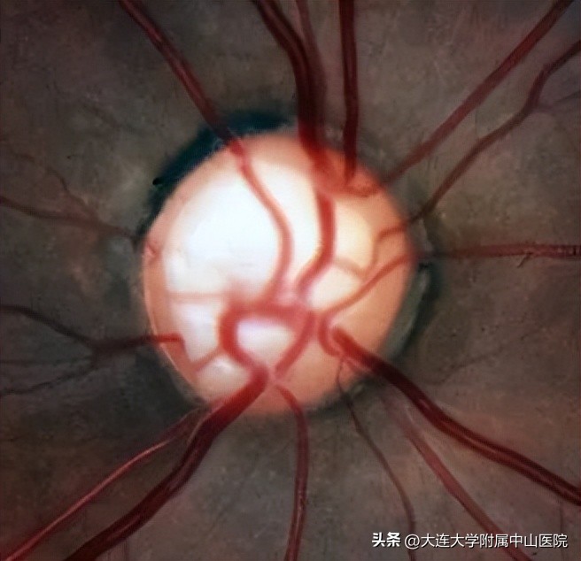 青光眼杯盘比用什么方法测量,世界青光眼日怎么防治