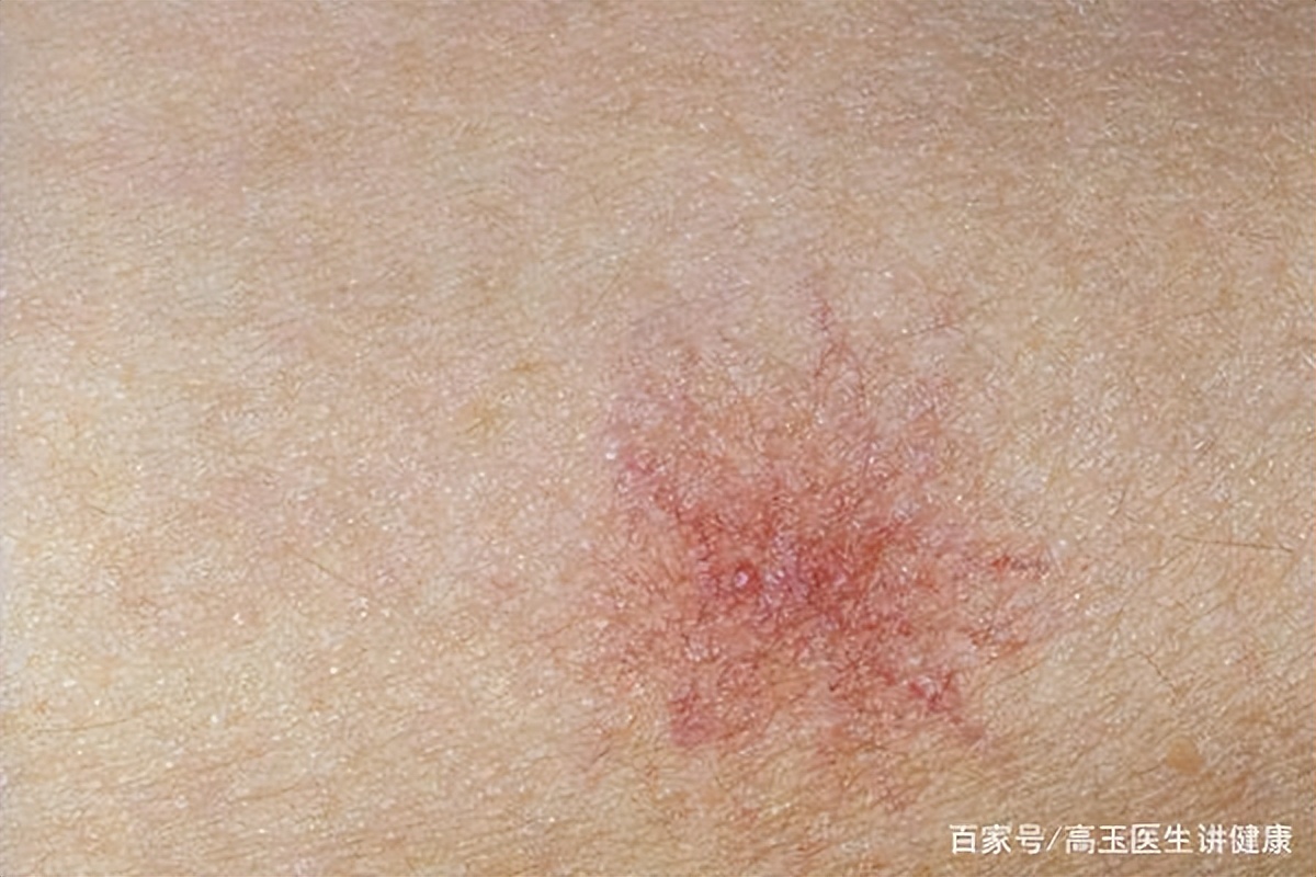 肝病皮肤出现蜘蛛痣有多严重,蜘蛛痣是肝病早期出现吗