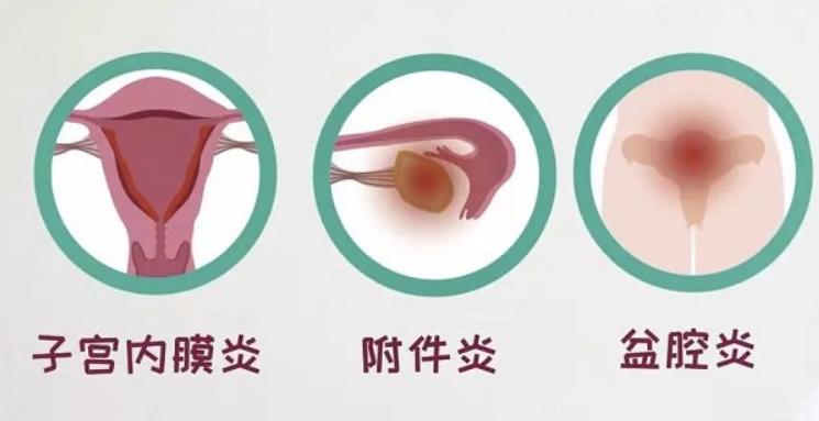 阴道护理科普,阴道常规保养