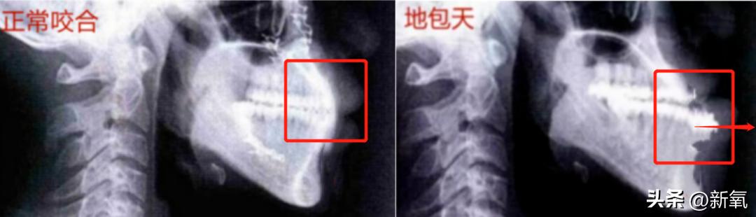牙齿正畸和骨骼正畸的区别,牙齿正畸和眼轴增长有关系吗