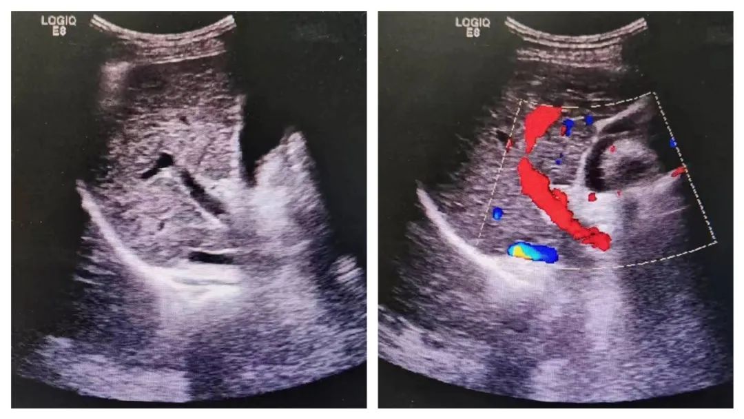 彩超是黑白的怎么看出来的,彩超图片是黑白的正常吗
