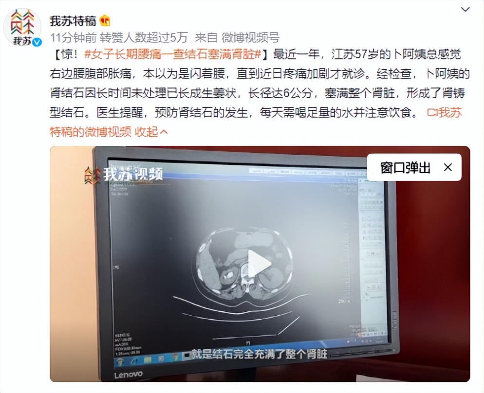 女子长期腰痛一查结石塞满肾脏,女性突然腰痛是不是有结石