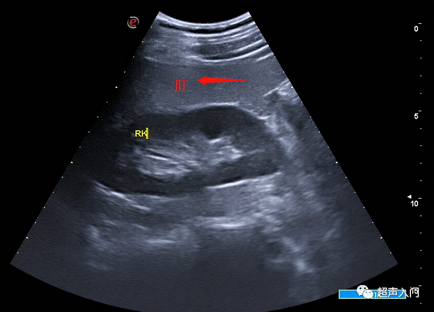 超声学自己能学吗,超声初学者有何窍门