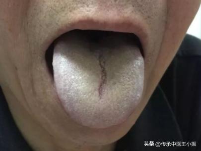 寒热舌诊图解大全,如何看舌象判断疾病准确用药