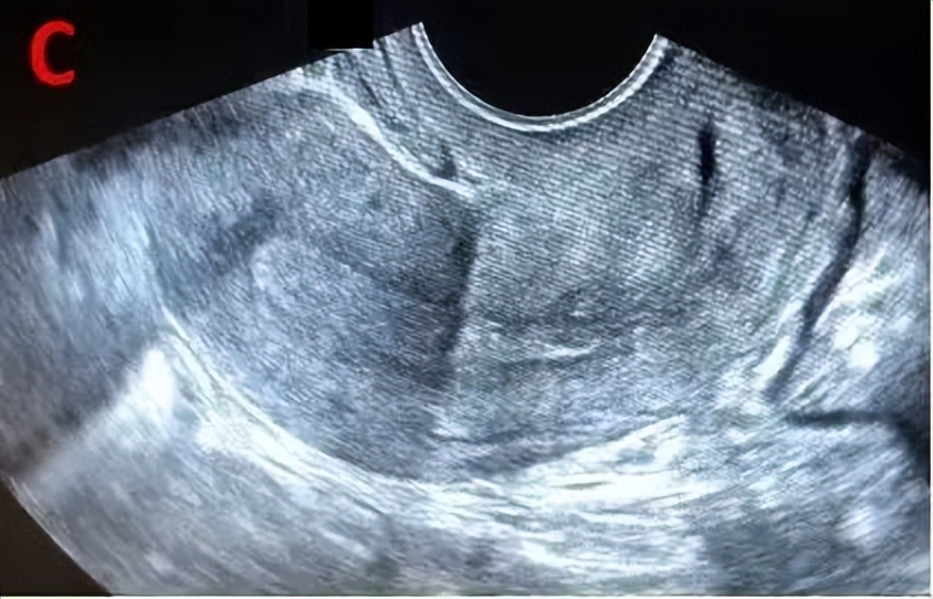 助您好孕——B超监测排卵不可不知道的细节