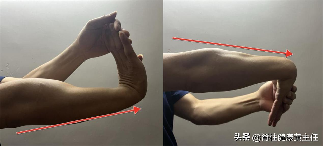 高尔夫球肘康复,什么是高尔夫球肘该如何治疗