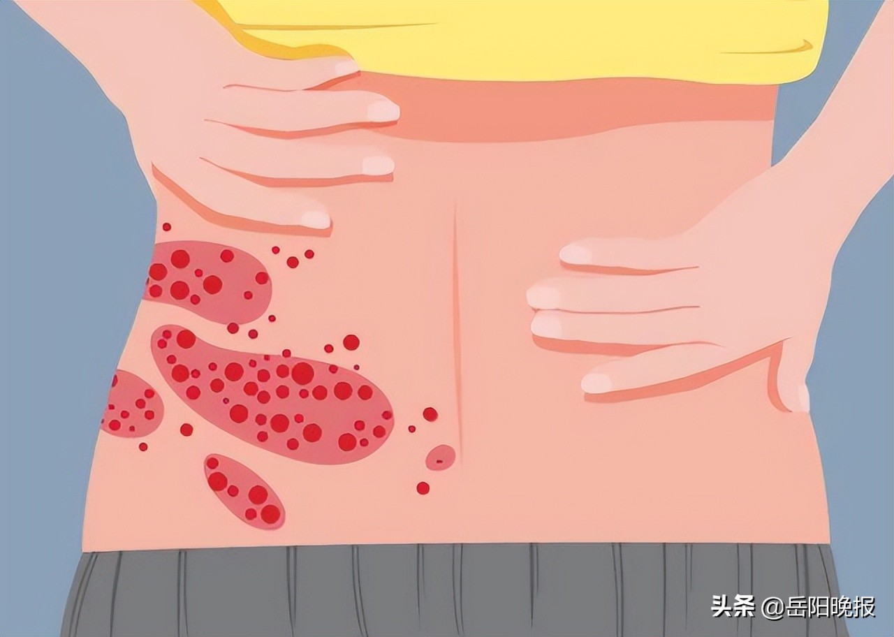 带状疱疹湖南省中医院,中医院皮肤科带状疱疹