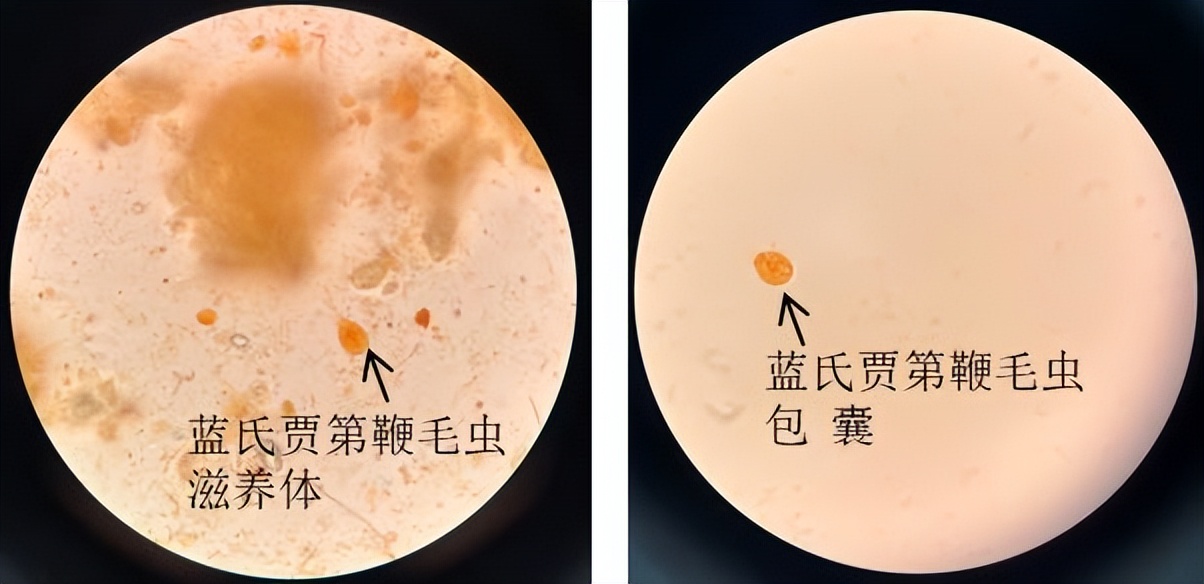 如果同时得了几种寄生虫病怎么治,现在寄生虫有哪些
