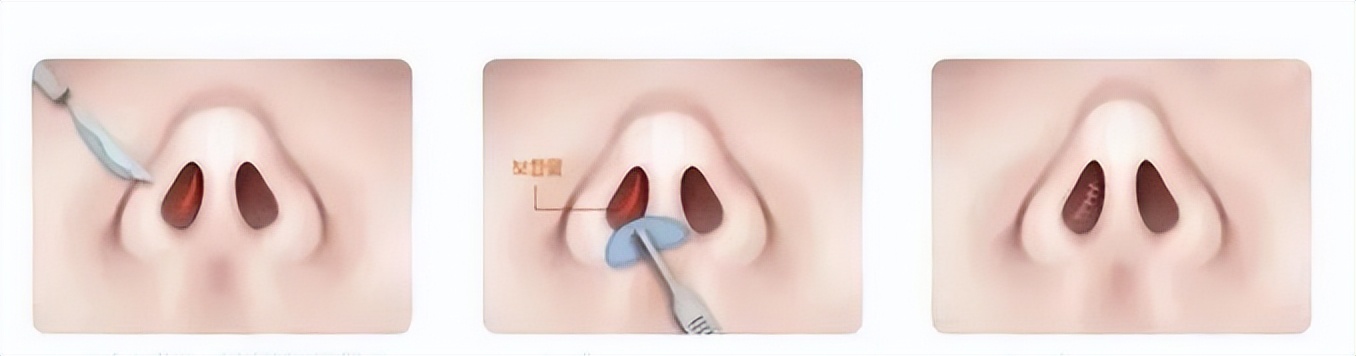【协和科普】同是隆鼻，为什么有的自然有的一眼被看穿？