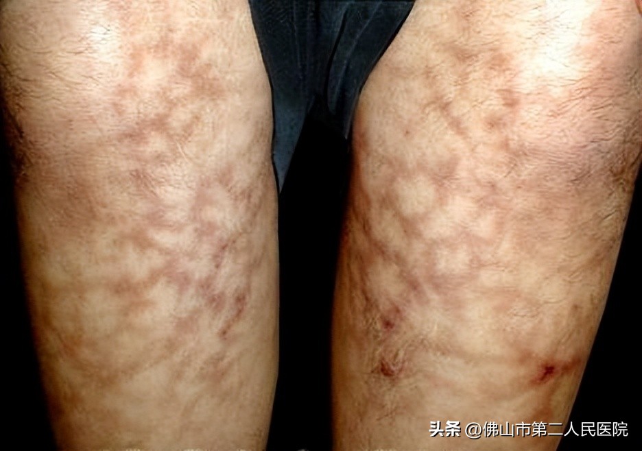 阳过之后皮疹怎么回事,阳了以后皮疹