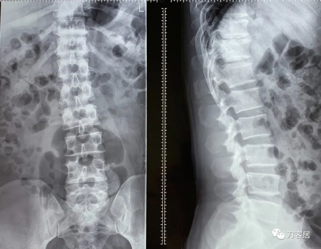 20岁腰5骶1椎间盘突出怎么办,腰5骶1椎间盘突出急性发作