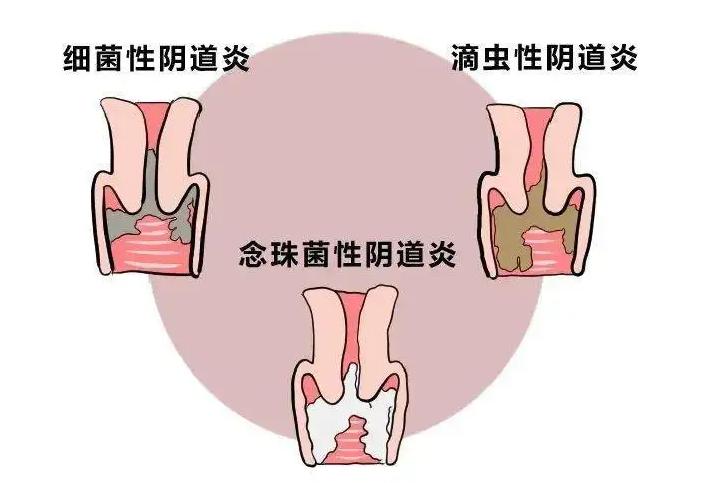 天天用洗液清洗外阴炎症会好吗,天天用洗液有炎症了怎么办