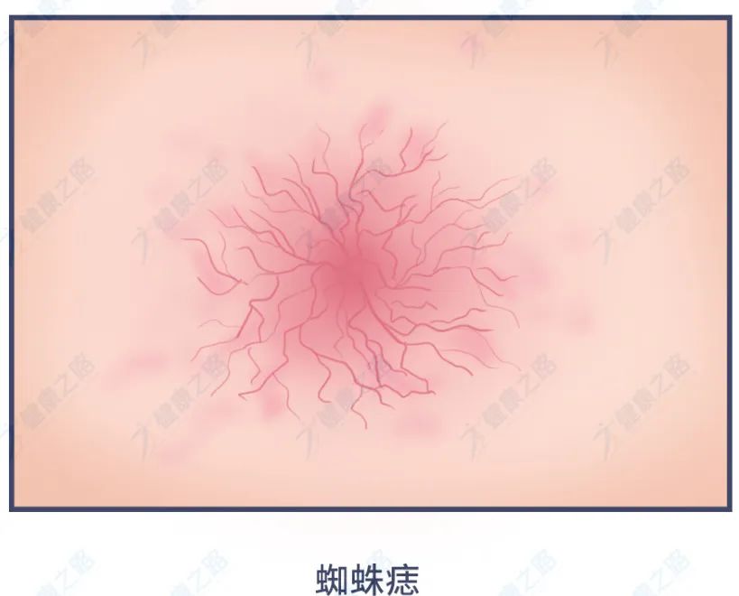 警惕身上出现的小黑痣,警惕皮肤黑痣