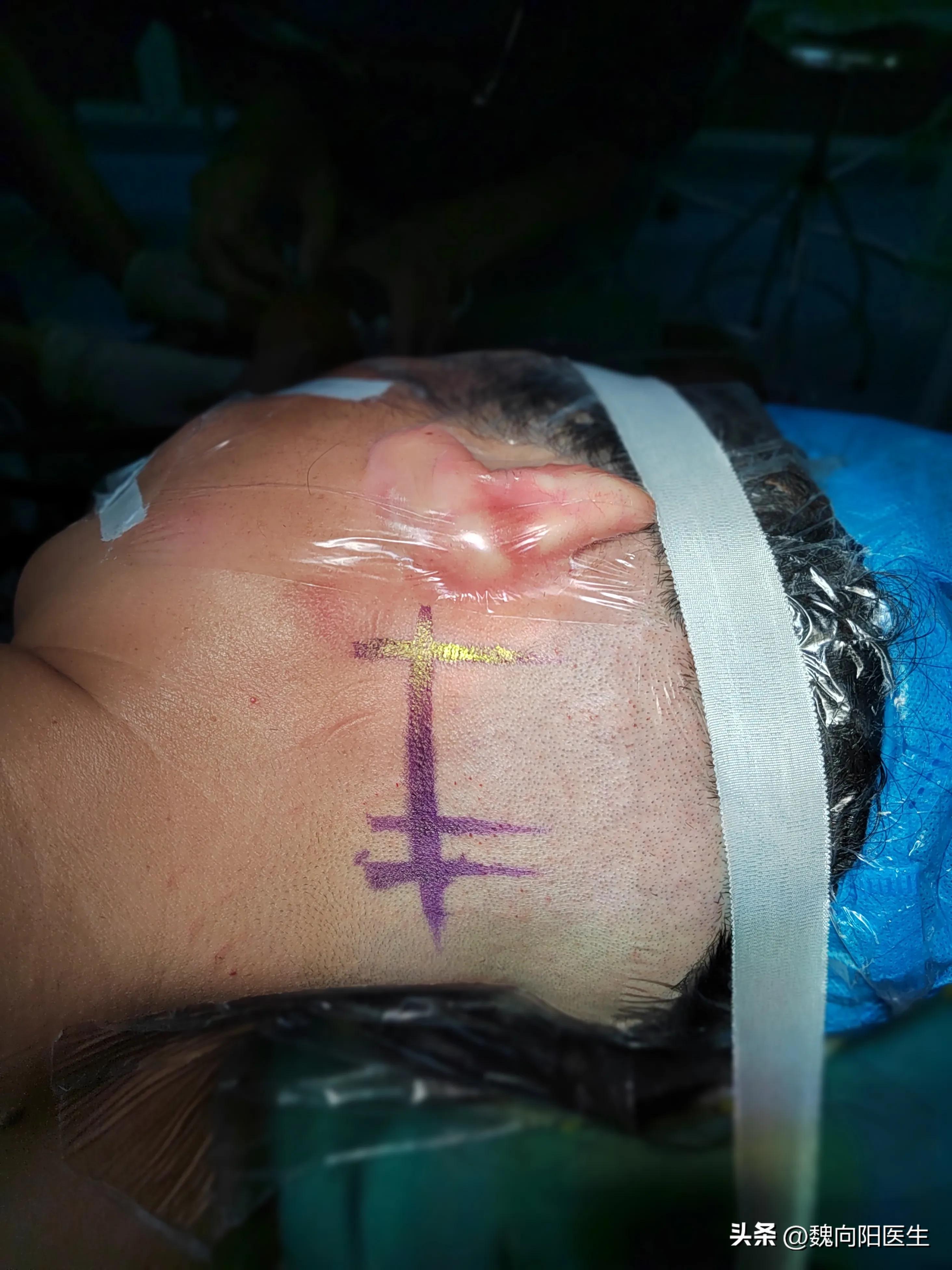 三叉神经痛可以针灸治疗吗,三叉神经痛是什么位置图片