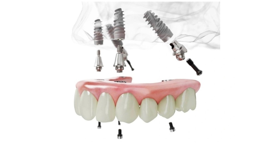 种植牙材料诺贝尔怎么样,瑞士诺贝尔高端种植牙