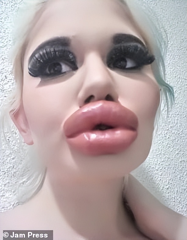 女子狂打30支玻尿酸,丰唇针建议打吗