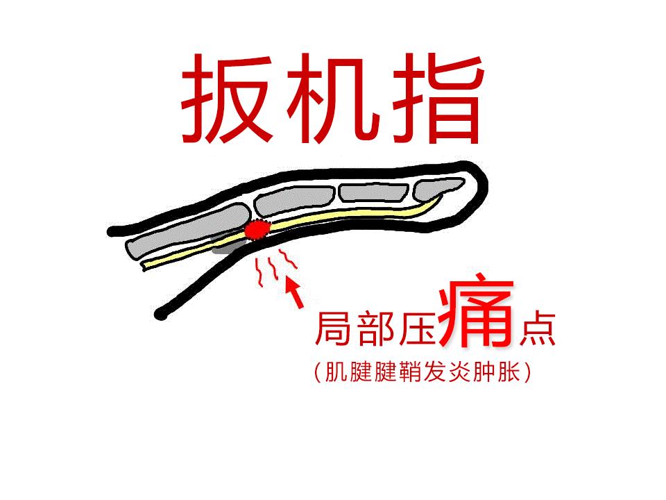 手指咔咔响疼怎么回事,扳机指是什么病的症状