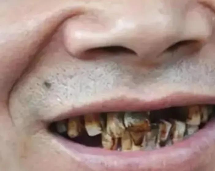 戒烟时戒断反应强烈怎么办,戒烟不能慢慢戒的原因