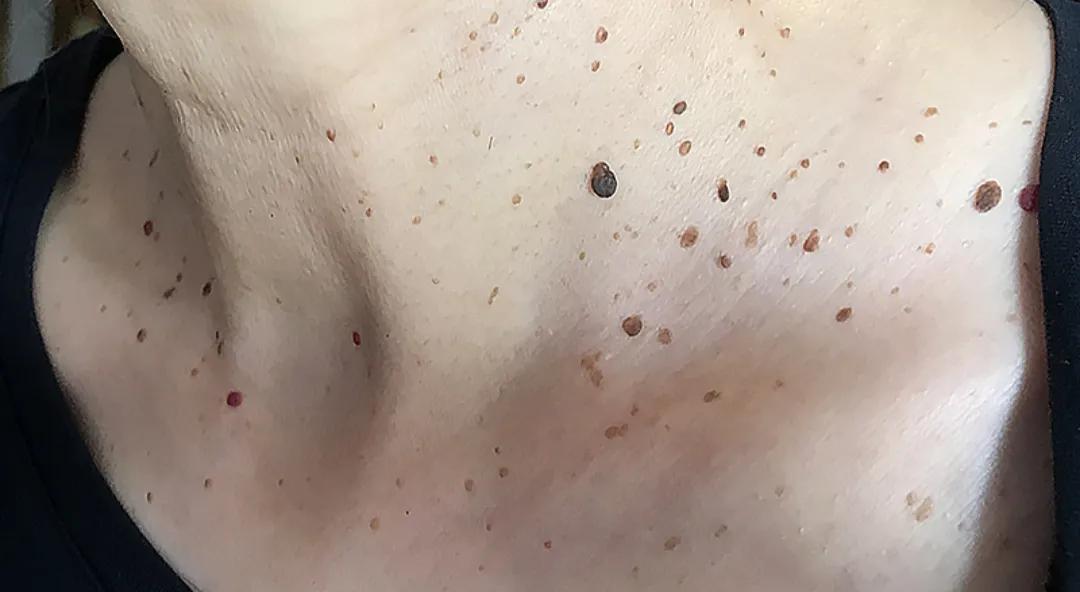 皮肤科董医生,皮肤科董医生的网络门诊分享