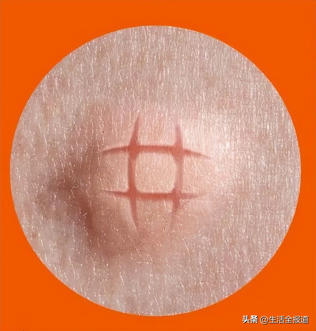 有什么老方法可以快速止痒蚊子包,怎么给蚊子包止痒