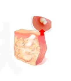 为什么说挤痘痘很危险,为什么说挤痘痘是往里面挤