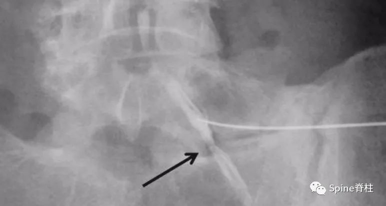 脊柱神经支配疼痛区域,脊柱神经支配的脏腑