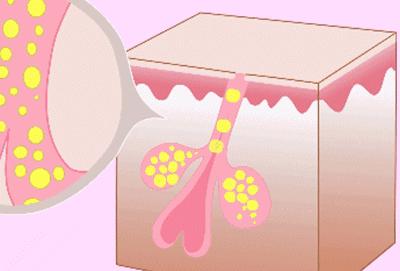 收缩毛孔粗大的方法,脸毛孔粗大的正确护肤方法