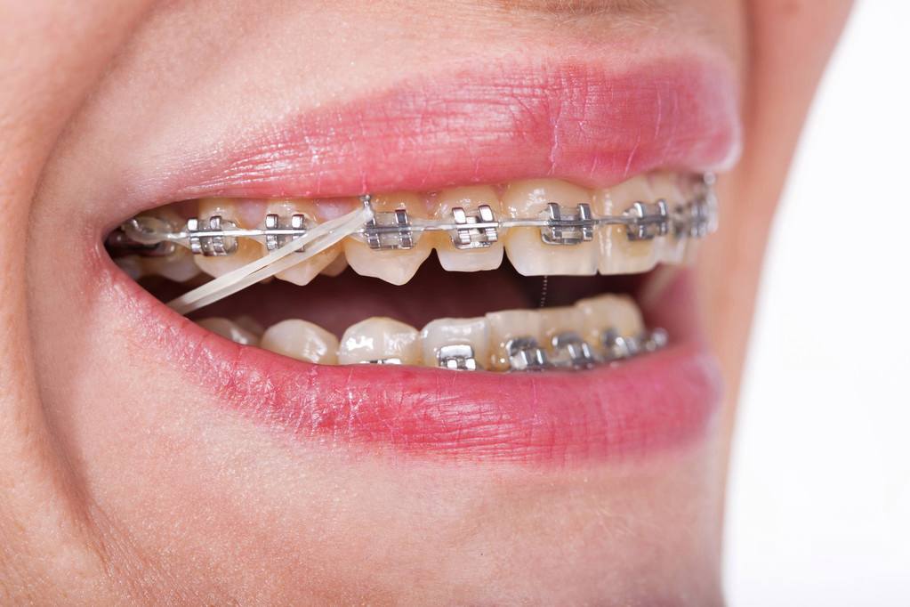 凸嘴形成的原因及凸嘴矫正方法,凸嘴如何改善