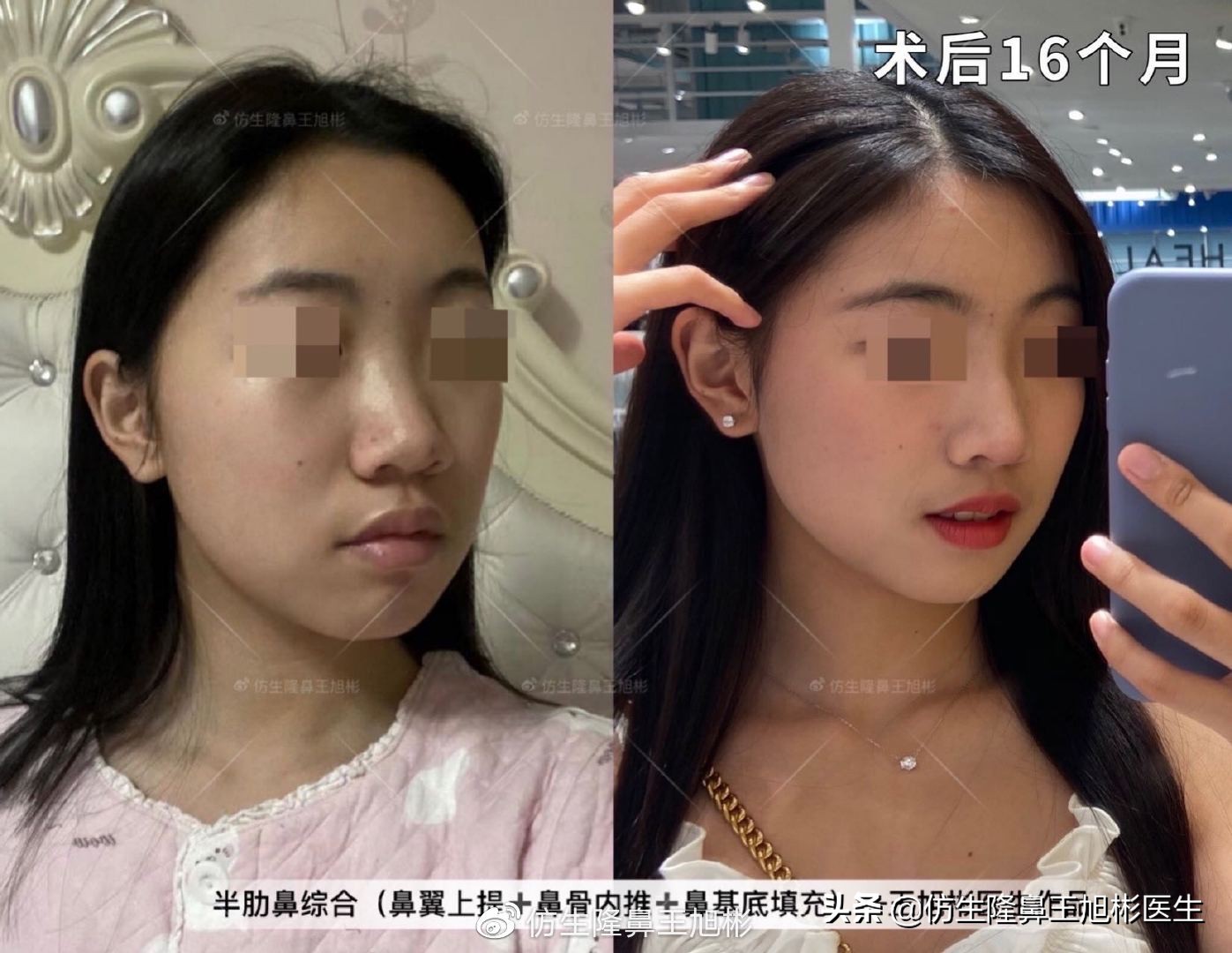 常见鼻部整形美容项目,整形鼻和自然鼻