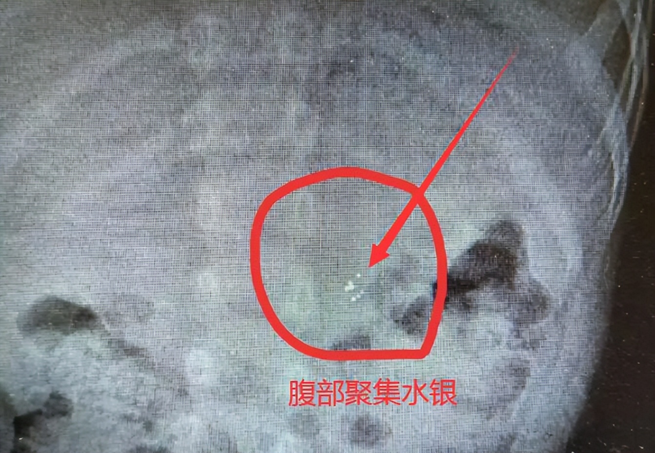 小孩咬破体温计水银要洗胃吗,小孩咬破了水银体温计头要催吐不