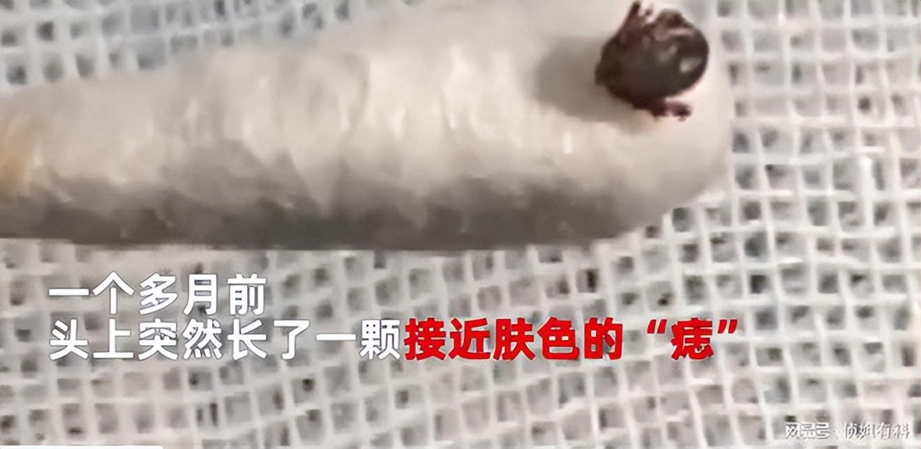 湖南一女孩被女蜱虫咬,女童野外游玩被蜱虫叮咬