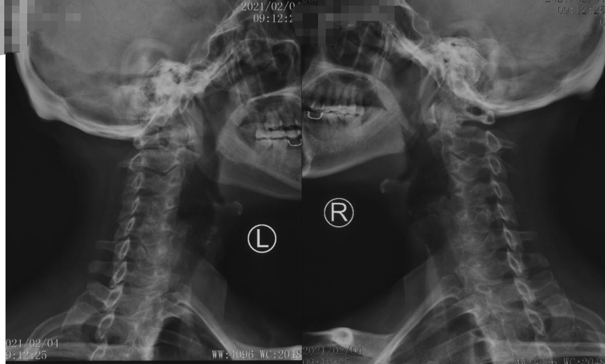 养花达人遇上右臂疼痛，原来是神经根型颈椎病在作祟