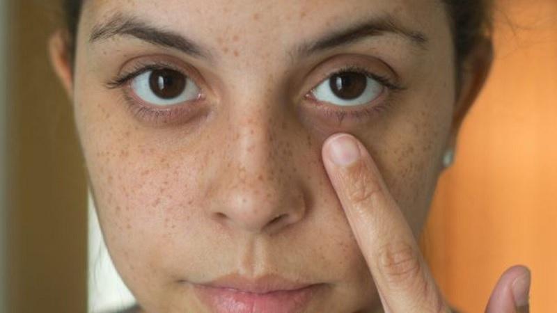 常年熬夜有黑眼圈怎么办,经常熬夜黑眼圈重吃什么