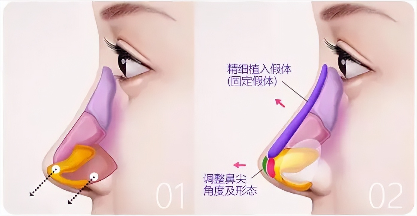 九院韦敏擅长做鼻头缩小,九院韦敏靠谱吗