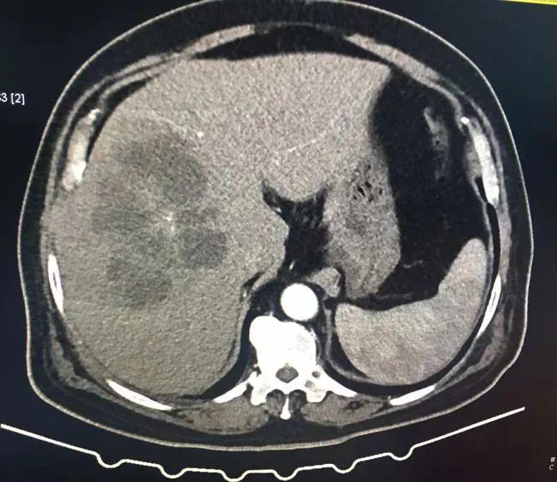 反复发热与什么有关,反复发热是什么病的前兆
