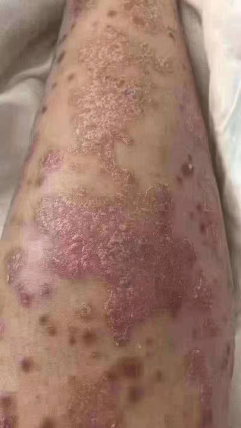 今年银屑病在我国的发病率高,银屑病发病率怎么样