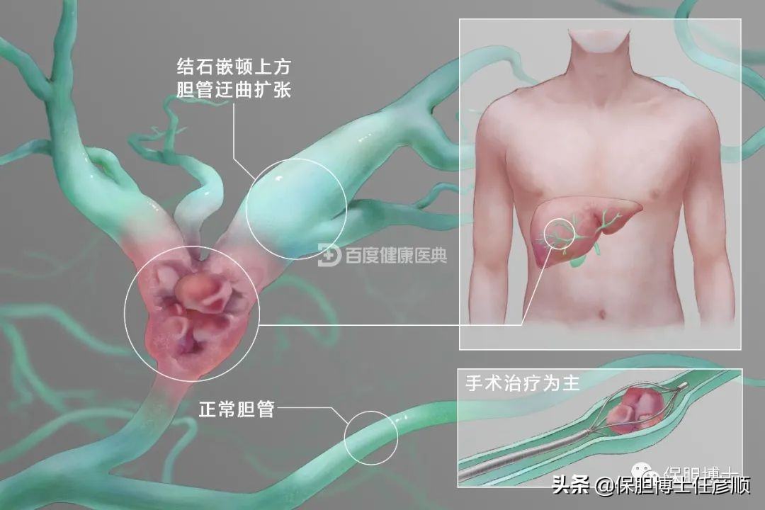 肝内胆管结石能保胆取石吗,肝脏结石能排吗
