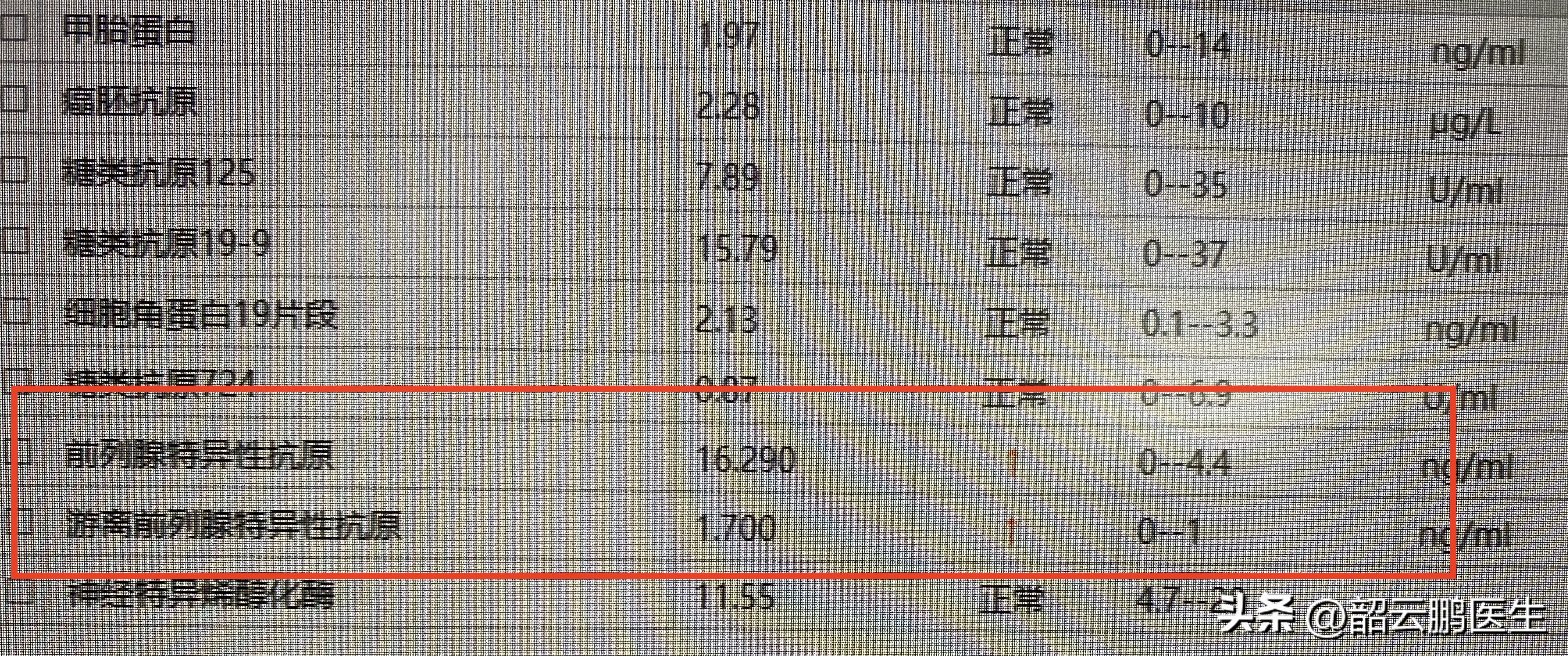 psa诊断早期前列腺癌的准确率,筛查前列腺psa需要空腹吗