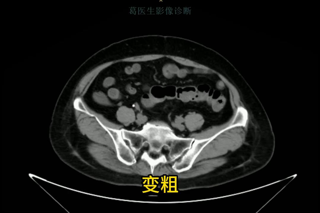 手把手教你看肺ct片,手把手带你看ct腹部