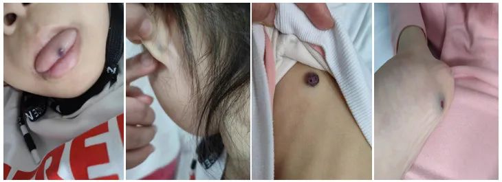 婴儿草莓状血管瘤怎么治疗 (宝宝贫血鲜红斑痣颜色)