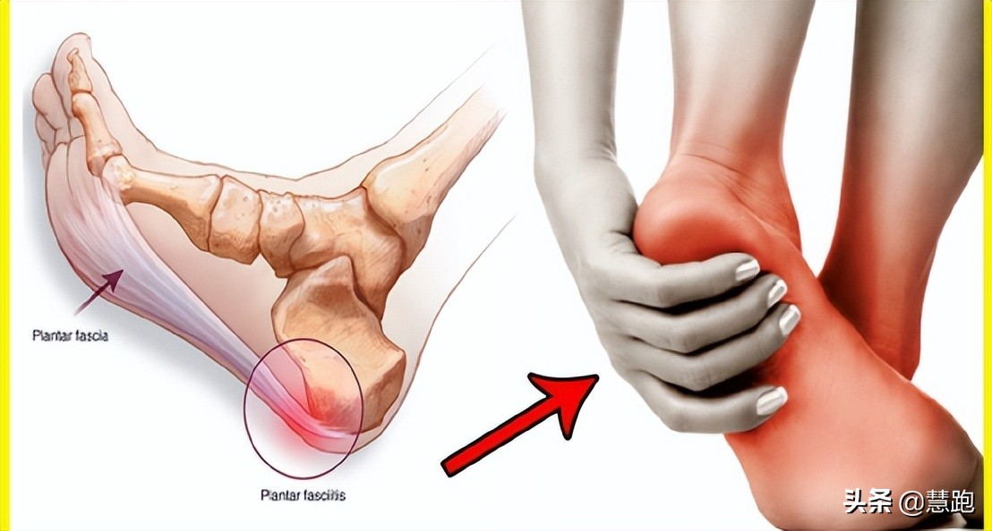 足底筋膜炎久治不愈怎么办,为什么足筋膜炎久治不愈